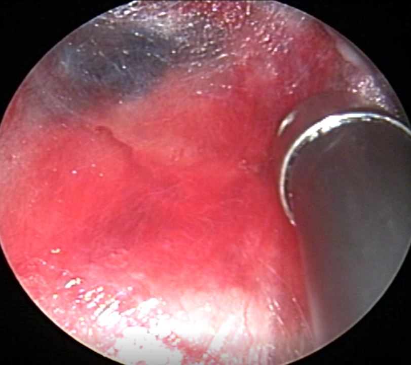 Mediastinoscopia